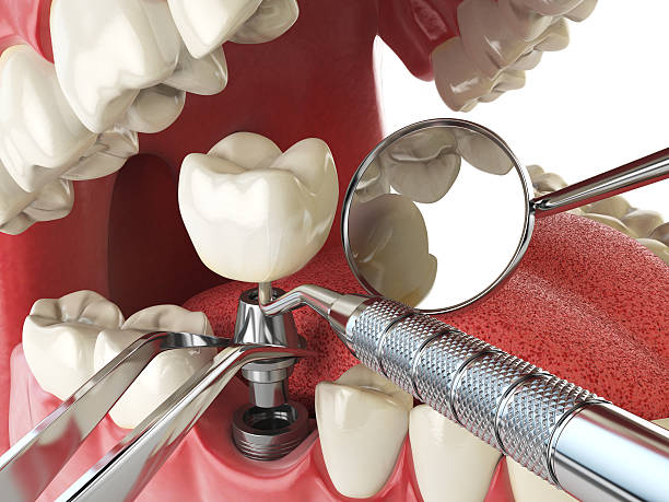 Best Emergency Dental Extractions in Catlin, IL